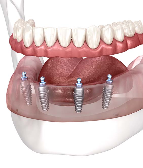 implant Denture in Cambridge