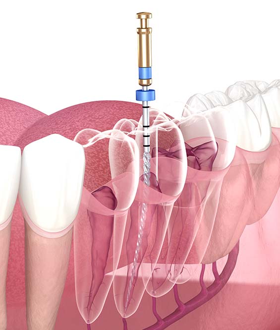 endodontics in Cambridge